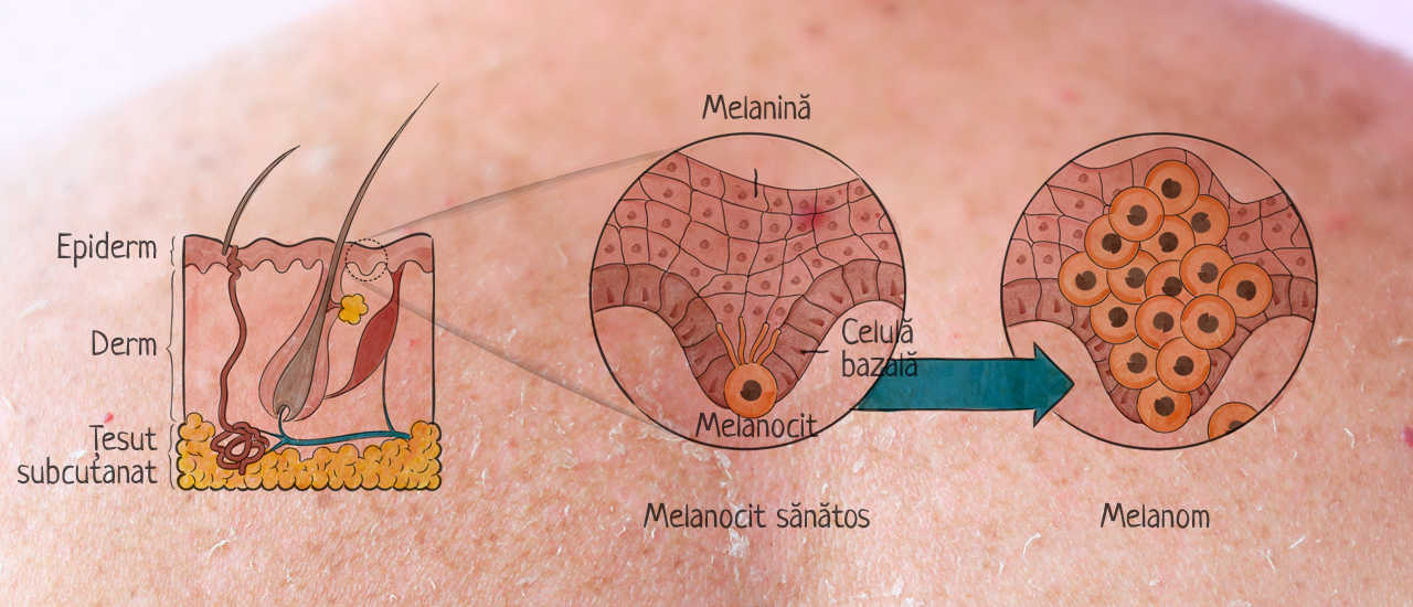 ce este melanomul