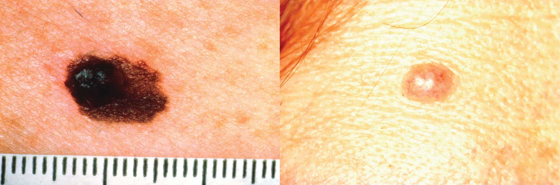 A = Asimetrie: Există o neconcordanță între cele două jumătăți ale unei alunițe sau ale unui semn din naștere