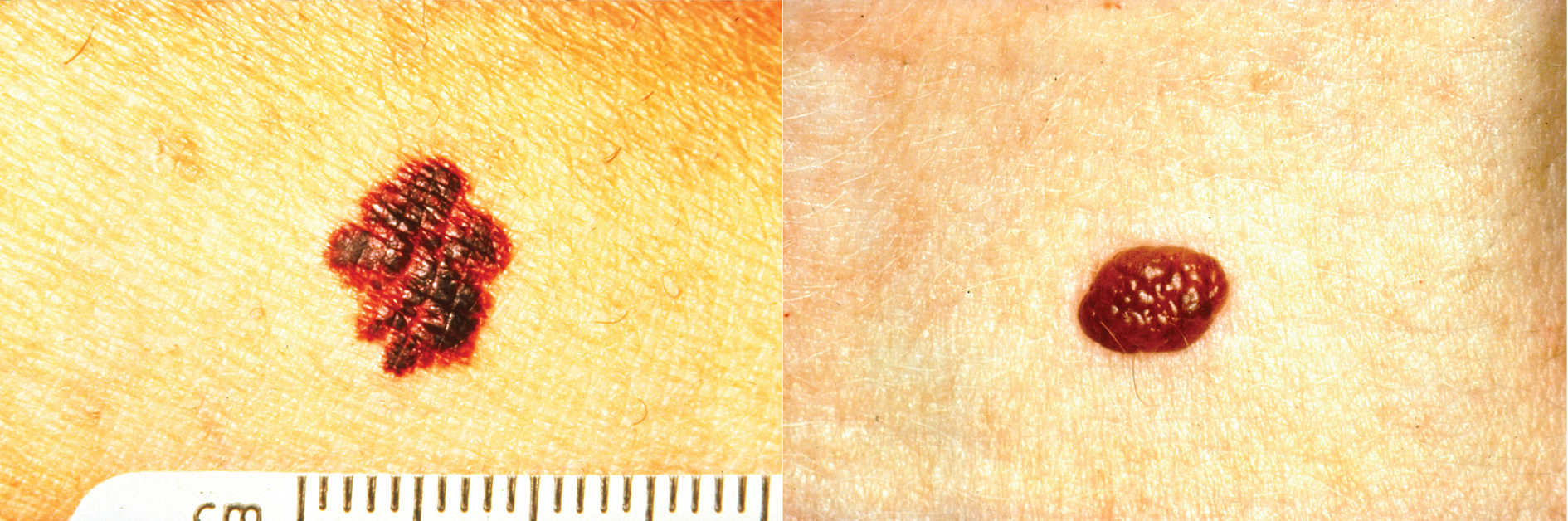 B = „Bordură”: Marginile sunt neregulate, crestate sau neclare