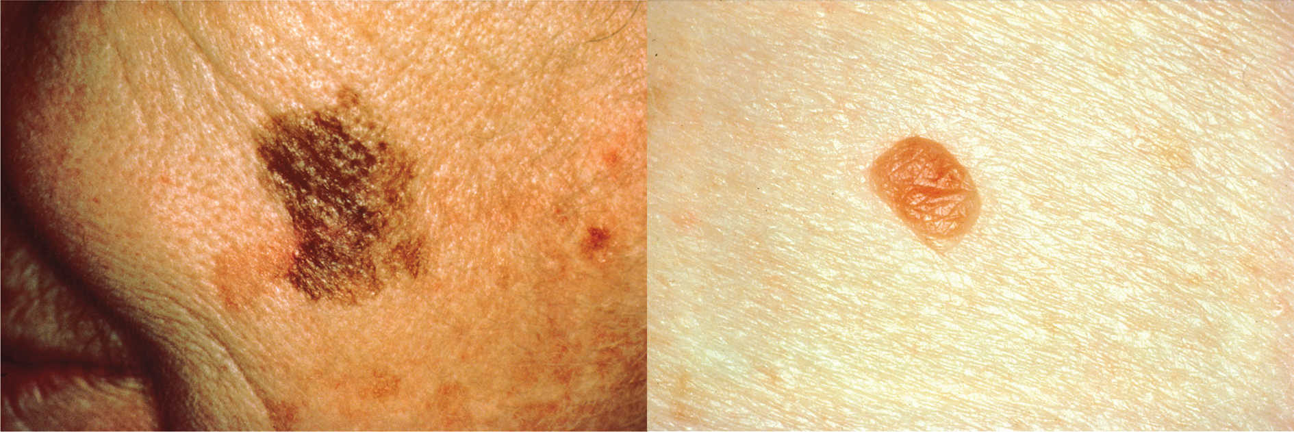 D = Diametru: Leziunea are un diametru mai mare de 6 mm, deși melanoamele pot avea și dimensiuni mai mici