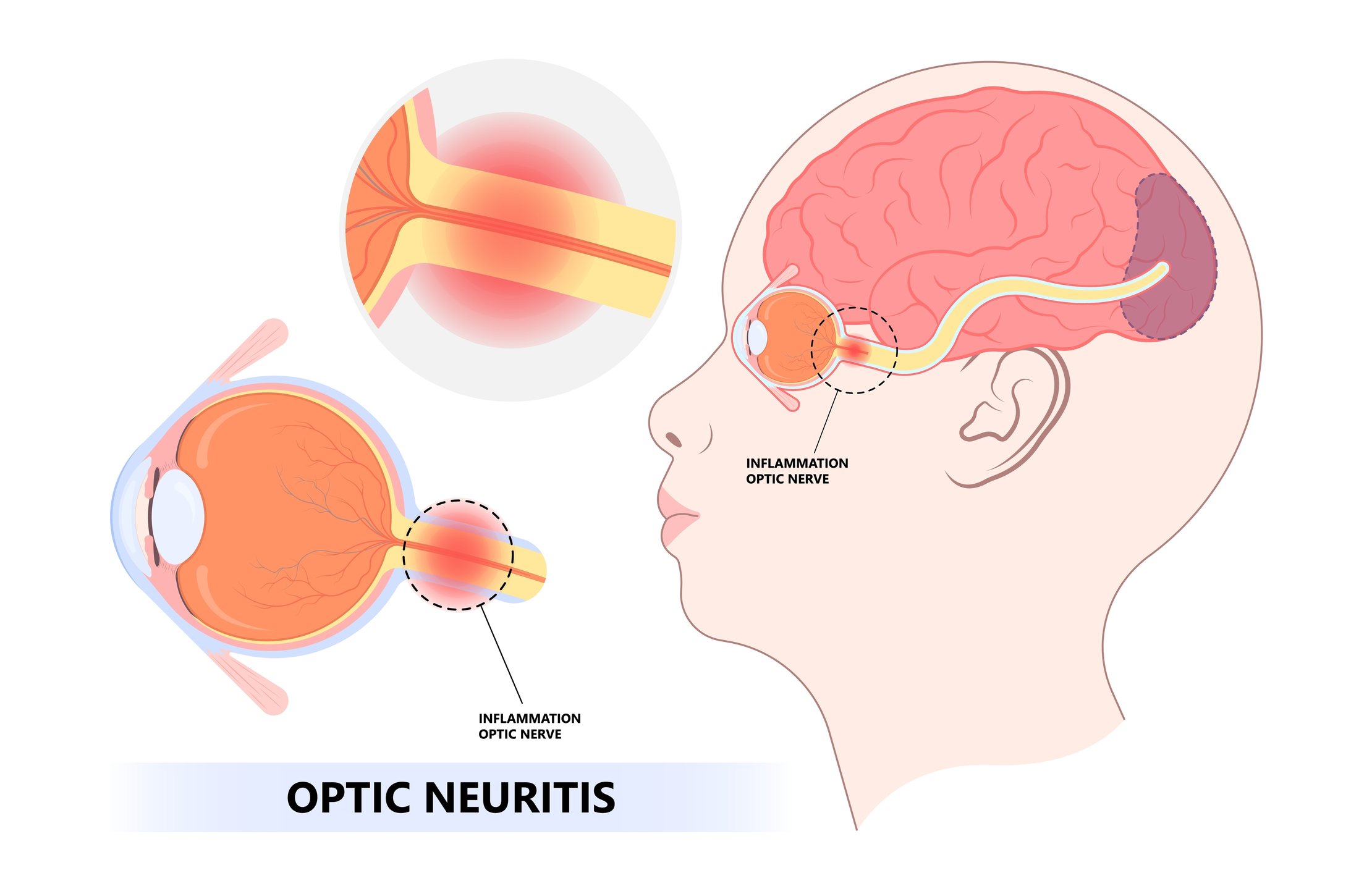 SCLEROZA MULTIPLĂ ȘI NEVRITA OPTICĂ