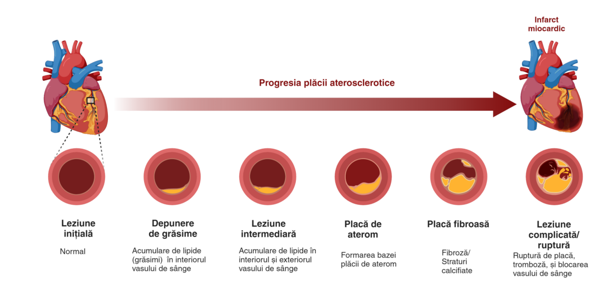 Progresia placii aterosclerotice