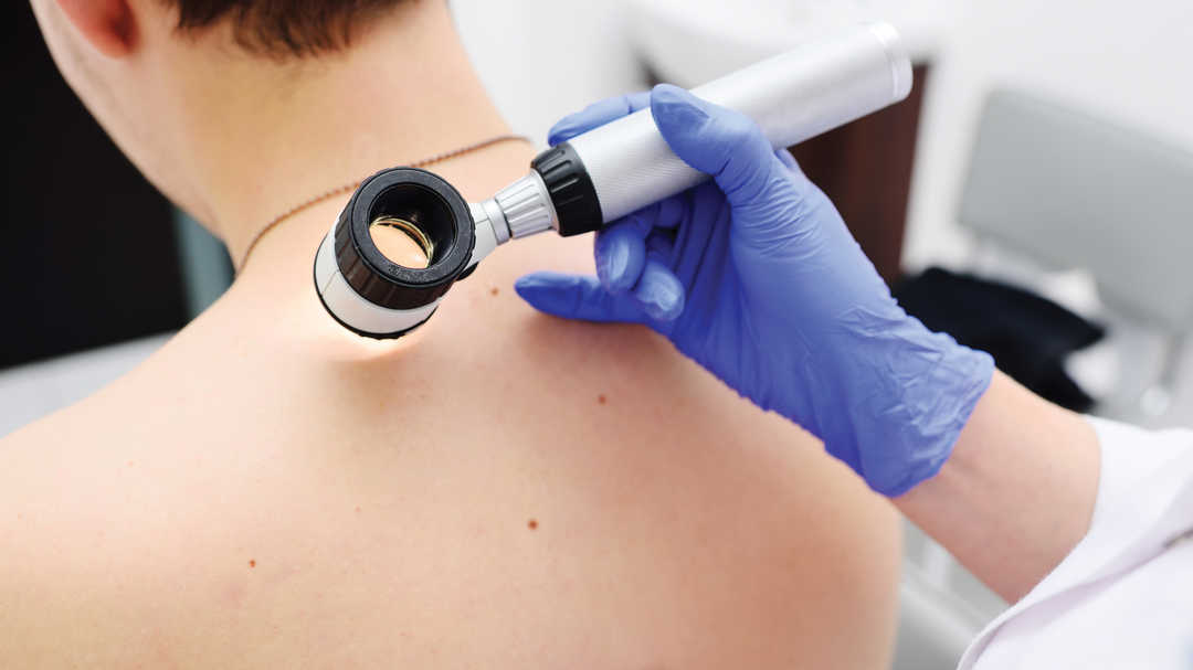 diagnosticat cu melanom